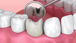 Причины потери зубов